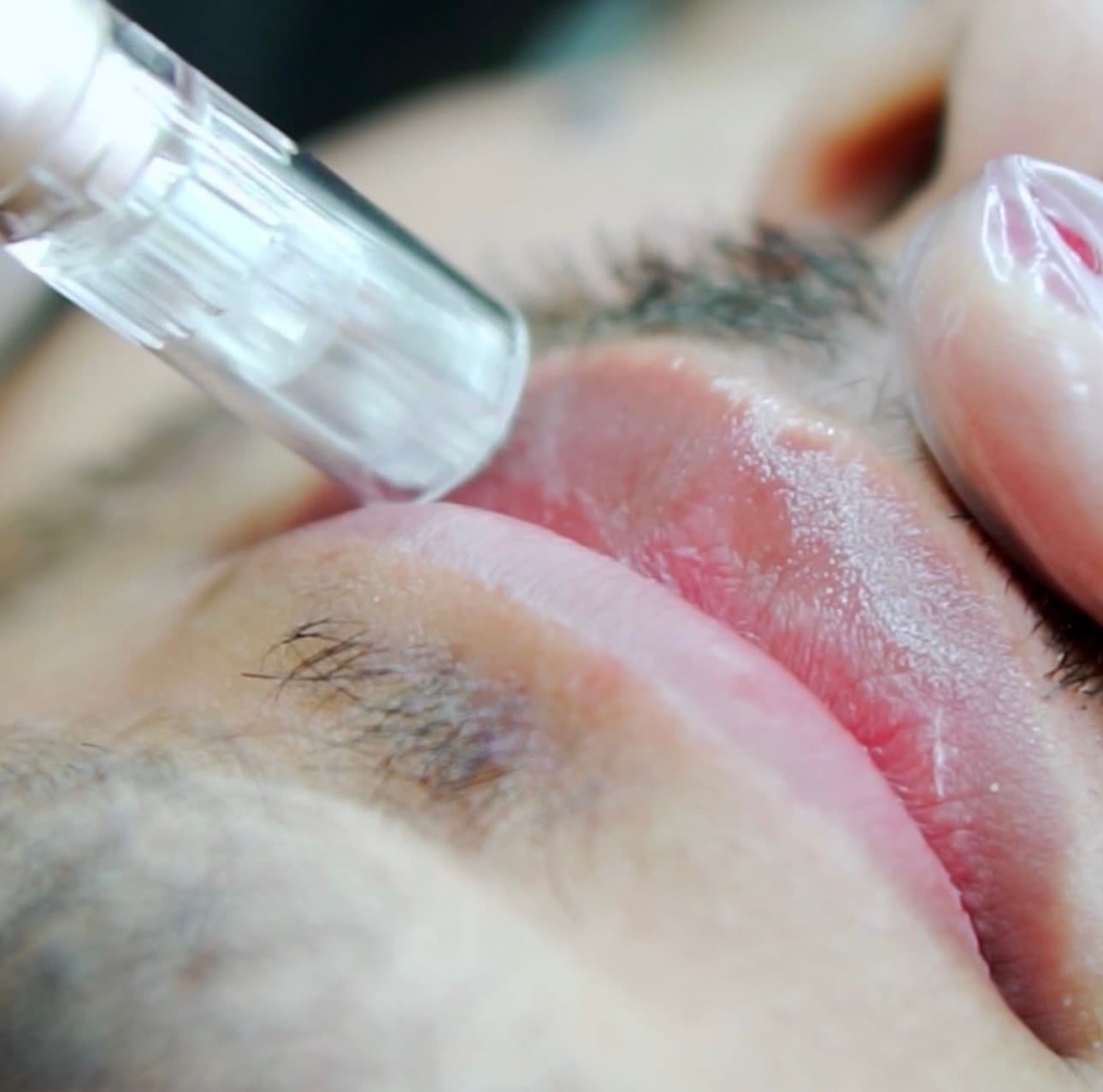 Procedimento de Hidragloss Labial